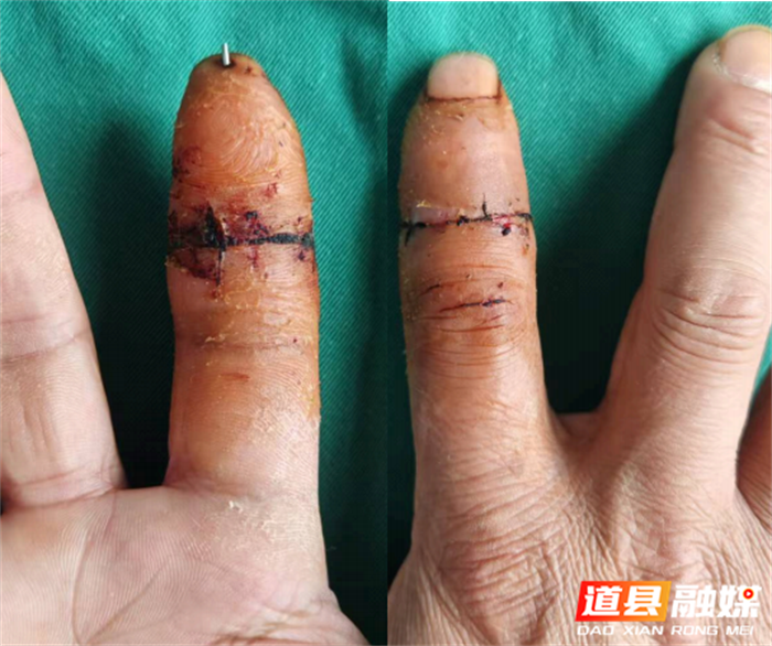 道县中医医院骨三科成功完成高难度断指再植手术_副本.png