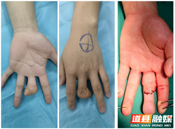 医疗服务提升年︱道县中医医院：妙手再造缺如指，真情点亮十年憾2_副本.png