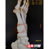卸下下肢护具就想跑？医生：别急，悠着点！