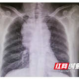 湘雅医院胸外科团队为巨大纵隔占位患者解决“心头大患”