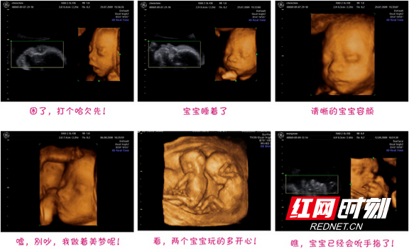 10周宝宝B超图片图片