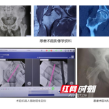 湘雅骨科“天玑”手术机器人辅助导航定位完成省内首例股骨头坏死保髋治疗