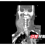 颈部包块竟是巨大颈动脉瘤 湘雅专家“拆弹”助患者脱险境