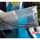 险！小伙吞下15cm长“夺命铁丝”，医生5分钟快速取出
