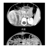 两岁幼儿体内巨大肿瘤随时破裂 湘雅多科合作为生命接力