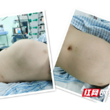 3岁女童“青蛙肚”原是巨瘤 离体肝切除+自体肝移植术后恢复良好