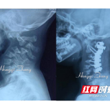 女子颈椎严重反曲畸形 湘雅专家助其脱离瘫痪危机