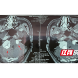 27岁男子突发耳鸣竟是患上罕见病 全球发病率仅为四万分之一