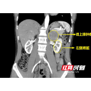 肿瘤悄无声息长到鹅蛋大 专家：高血压难控制小心肾上腺肿瘤