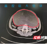 24岁女性盆腔查出巨大包块 这类疾病治疗一定要趁早