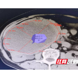 六旬大妈突然腹胀如身孕 医生手术切除10斤肿瘤