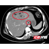 21岁衡阳男子久坐不动常喝饮料 血糖超标20多倍住进EICU