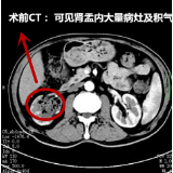 “老糖友”小便拉出果冻样颗粒 竟是它在作祟
