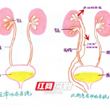 “三肾”女童长期漏尿 原是输尿管“跑偏”了