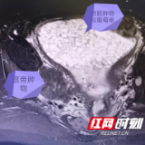 HCG值升高一定就是怀孕？肿瘤专家提醒：需要排除恶性葡萄胎