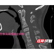 被同学扭了一下脖子 11岁男孩住进医院