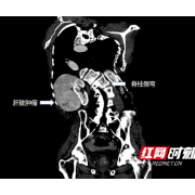 脊柱侧弯成“口袋”肿瘤藏在“山洞”里 肝胆专家另辟蹊径巧手术