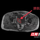 男子尿频尿急尿痛问“百度” 自行用药延误治疗切除膀胱