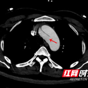 男子突发致命主动脉夹层 湖南省人民医院开通绿色通道成功“拆弹”