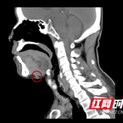 男子下巴上长包块 竟是因为4个月前吞下的鱼刺