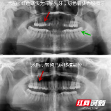 “变废为宝” 自体牙移植让女子装上“原装”牙