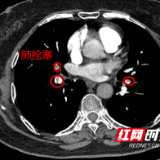 胸痛不一定是冠心病 也有可能是同样致命的肺栓塞 