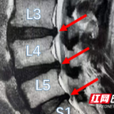 男子打麻将后双腿无法动弹 医生提醒：严重者或致瘫痪