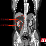 女子腰痛以为腰椎间盘突出 不料是肾脏长了巨大肿瘤