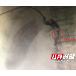 拉肚子瘦了30多斤还变成“小黄人” 原是得了这种病