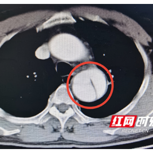 男子咳嗽4个月不见好 检查发现致命主动脉夹层