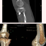 化繁为简 长沙市中医医院一次手术解决三难题
