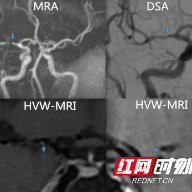 高分辨血管壁MR成像,脑血管病患者的福音