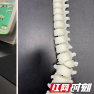 长沙市中医医院:3D打印技术助力脊柱侧弯少女“挺直腰杆”