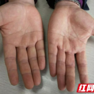 男子左手拇指不幸重伤，高难度 “移花接木”完美修复