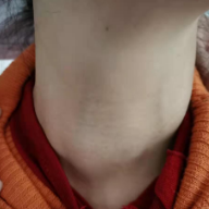 春季高发!这个病与感冒非常相似,预防需要这样做