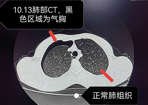 入院时的CT检查显示：气胸、肺组织被压缩了20%～30%。.jpg