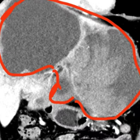 58岁男子肚子变大还恶心、呕吐,竟然是这个原因