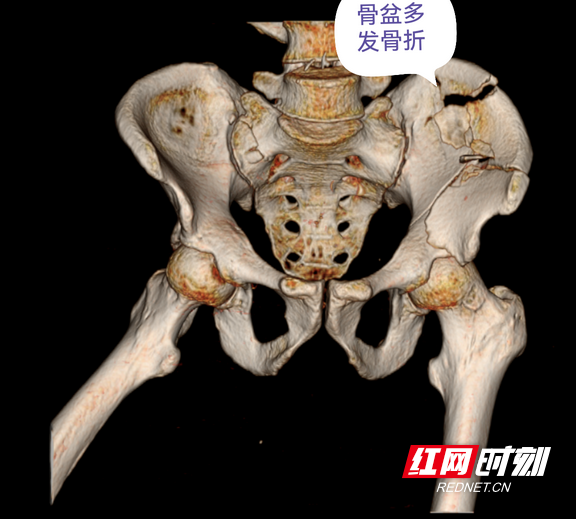 影像显示：骨盆多发骨折。.wm.png