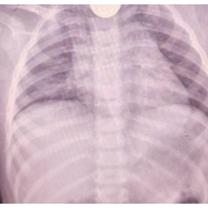 一岁女童误吞硬币 长沙市妇幼保健院医生紧急手术取出异物