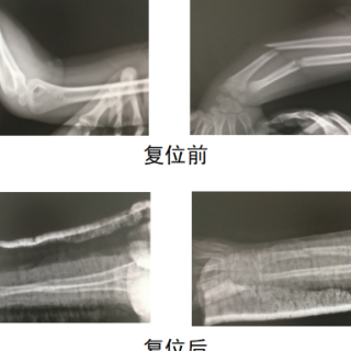 5岁孩子胳膊摔成“S”型，不开刀也能成功愈合