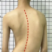 湖南省康复医院开展脊柱侧弯公益筛查 为青少年脊柱健康护航