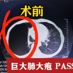 为肺“放气”，微创减容术让肺大疱患者重获畅快呼吸