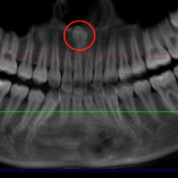 少年多生牙长错位 医生“绕道”鼻子里拔牙