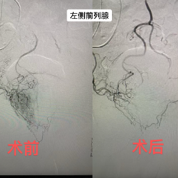 2毫米针孔解决大问题,69岁老人告别“方便”难题