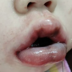 1岁半女童误吞管道疏通剂住进ICU 医生提醒家有幼儿谨防误食
