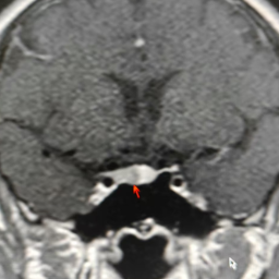 抽血后瘀斑不散,背后竟隐藏罕见库欣综合征