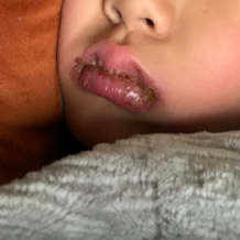 孩子嘴唇长泡溃烂，别总当“上火”！警惕冬季高发儿童唇炎