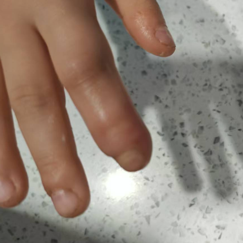 孩子爱咬指甲？当心“咬”出大问题！
