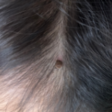 一岁宝宝头皮遭蜱虫叮咬 正确处理方法看这里