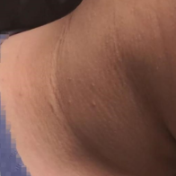 别把孩子“黑脖子”当污垢！11岁男孩确诊胰岛素抵抗，每5个孩子就有1个超重